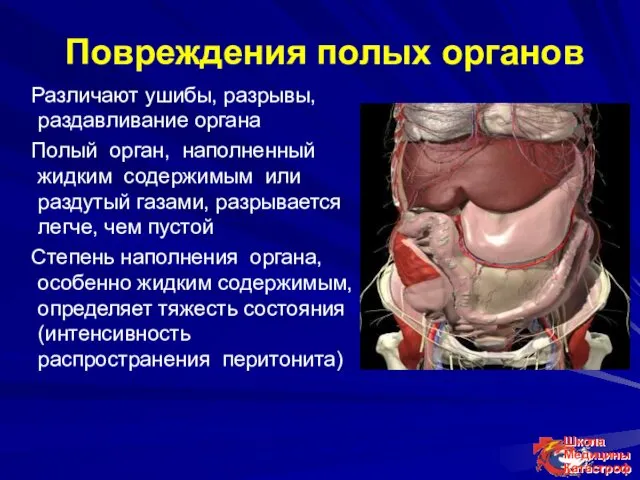 Повреждения полых органов Различают ушибы, разрывы, раздавливание органа Полый орган,