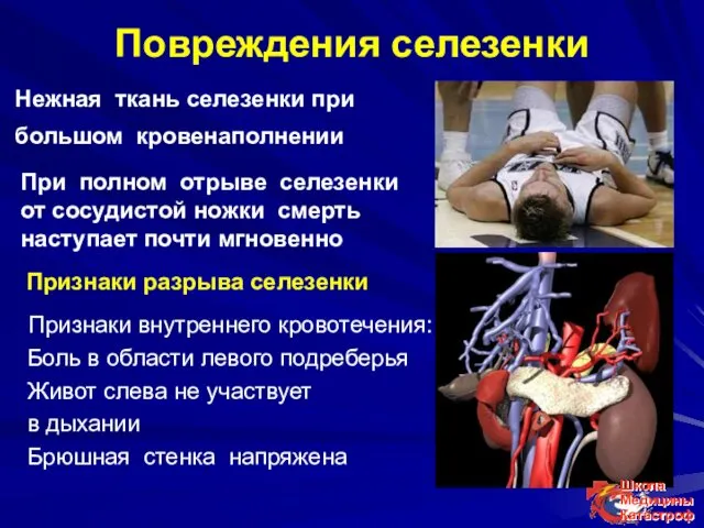 Повреждения селезенки Нежная ткань селезенки при большом кровенаполнении При полном