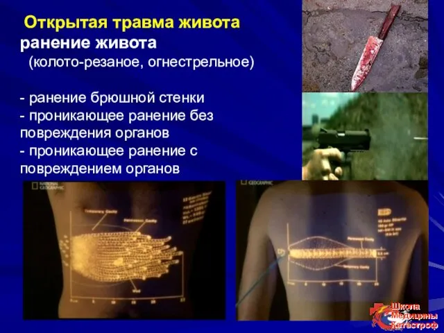 Открытая травма живота ранение живота (колото-резаное, огнестрельное) - ранение брюшной