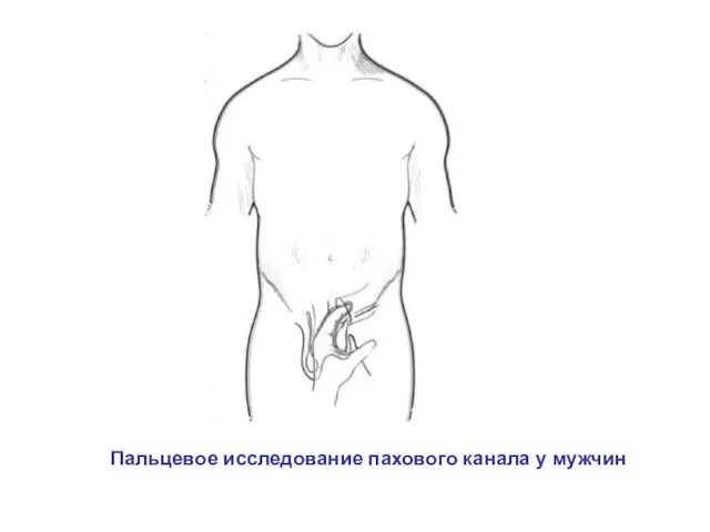 Пальцевое исследование пахового канала у мужчин