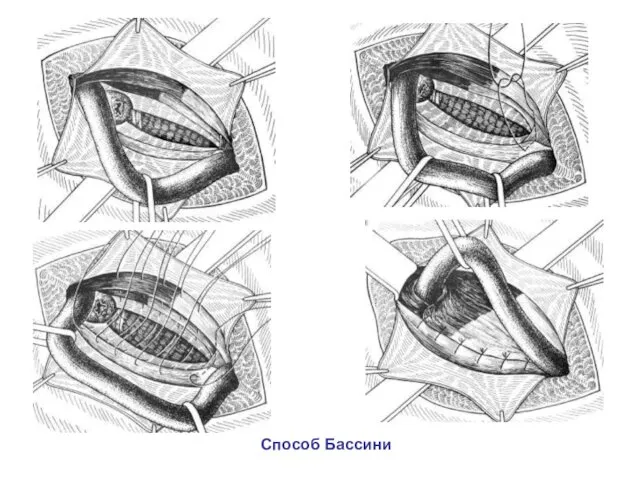 Способ Бассини