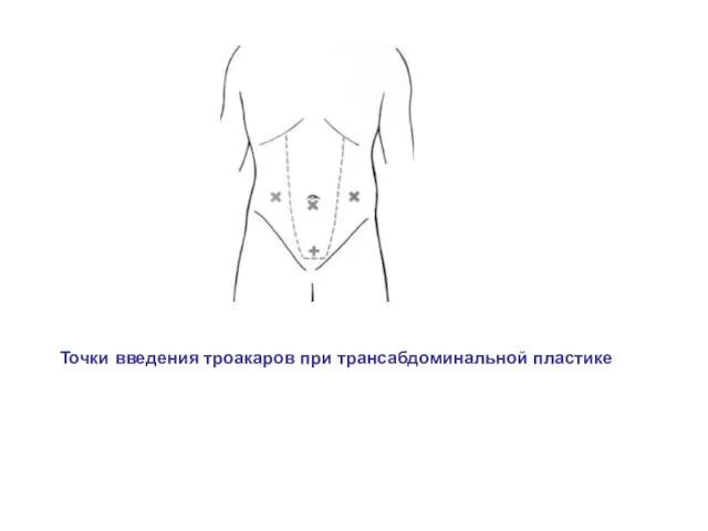 Точки введения троакаров при трансабдоминальной пластике
