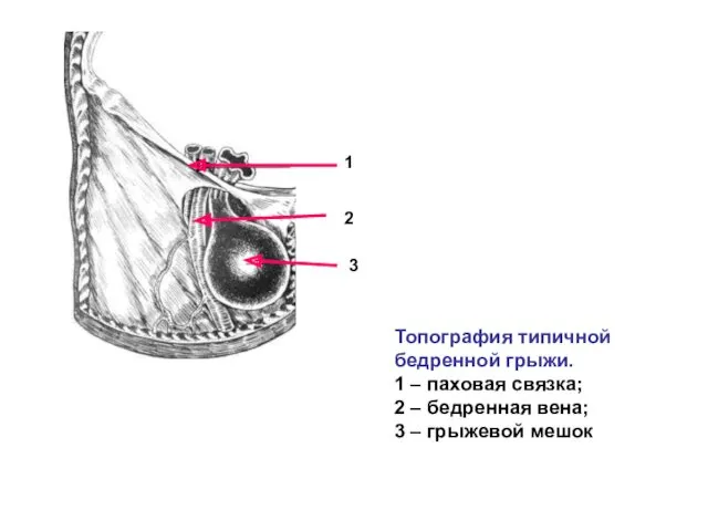 Топография типичной бедренной грыжи. 1 – паховая связка; 2 –