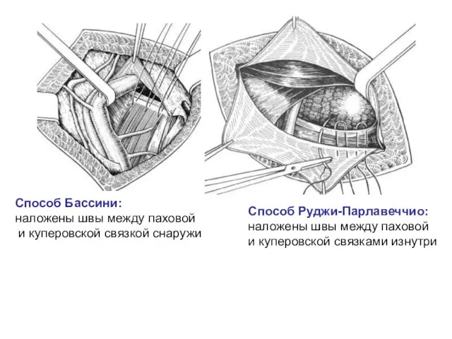 Способ Бассини: наложены швы между паховой и куперовской связкой снаружи