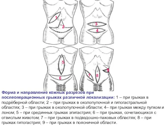 Форма и направление кожных разрезов при послеоперационных грыжах различной локализации: