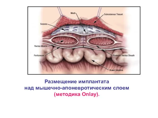 Размещение имплантата над мышечно-апоневротическим слоем (методика Onlay).