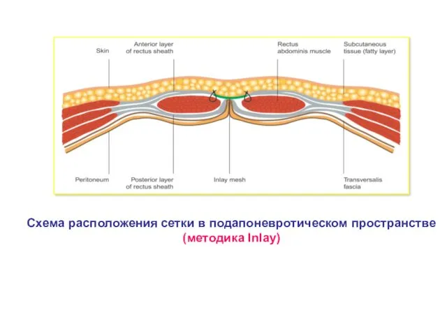 Схема расположения сетки в подапоневротическом пространстве (методика Inlay)