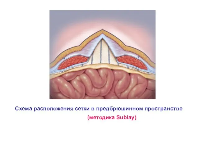 (методика Sublay) Схема расположения сетки в предбрюшинном пространстве