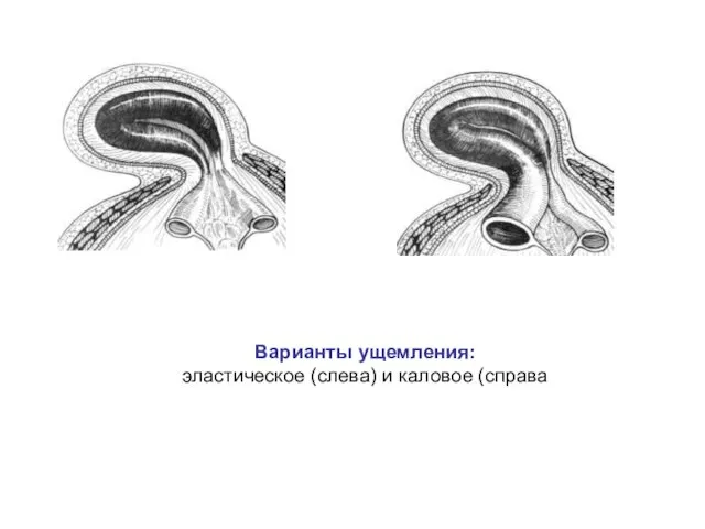 Варианты ущемления: эластическое (слева) и каловое (справа