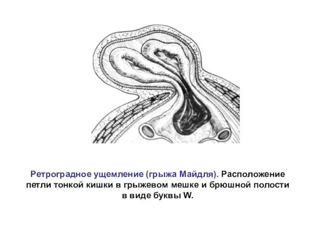 Ретроградное ущемление (грыжа Майдля). Расположение петли тонкой кишки в грыжевом