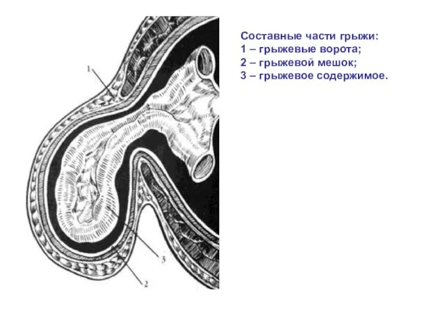 Составные части грыжи: 1 – грыжевые ворота; 2 – грыжевой мешок; 3 – грыжевое содержимое.