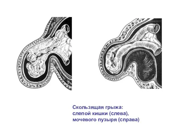 Скользящая грыжа: слепой кишки (слева), мочевого пузыря (справа)