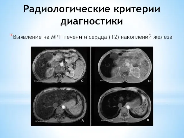 Радиологические критерии диагностики Выявление на МРТ печени и сердца (Т2) накоплений железа
