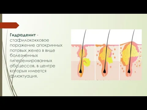 Гидраденит - стафилококковое поражение апокринных потовых желез в виде болезненных