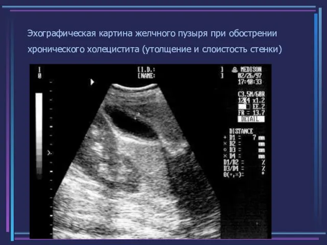 Эхографическая картина желчного пузыря при обострении хронического холецистита (утолщение и слоистость стенки)