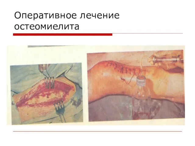 Оперативное лечение остеомиелита