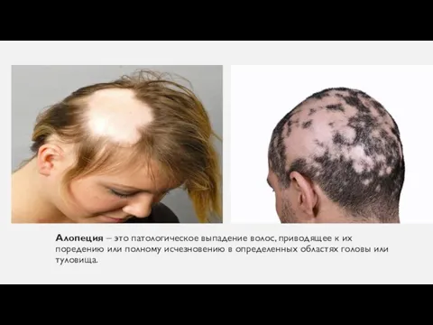 Алопеция – это патологическое выпадение волос, приводящее к их поредению