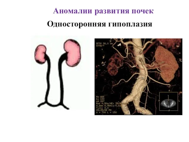 Аномалии развития почек Односторонняя гипоплазия