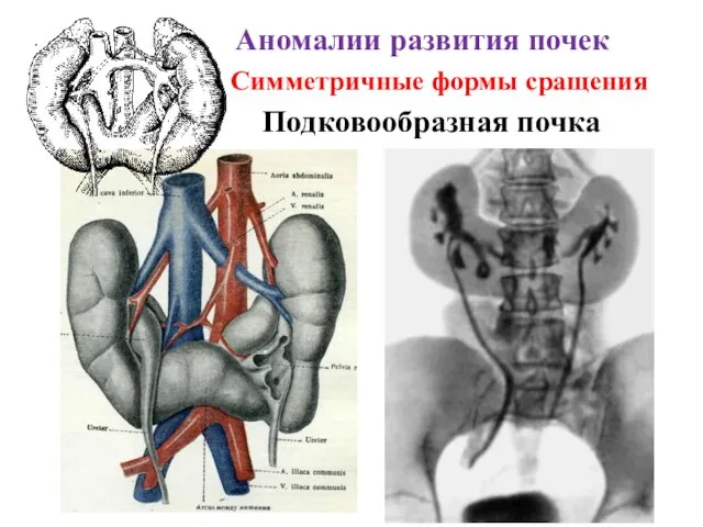 Аномалии развития почек Подковообразная почка Симметричные формы сращения