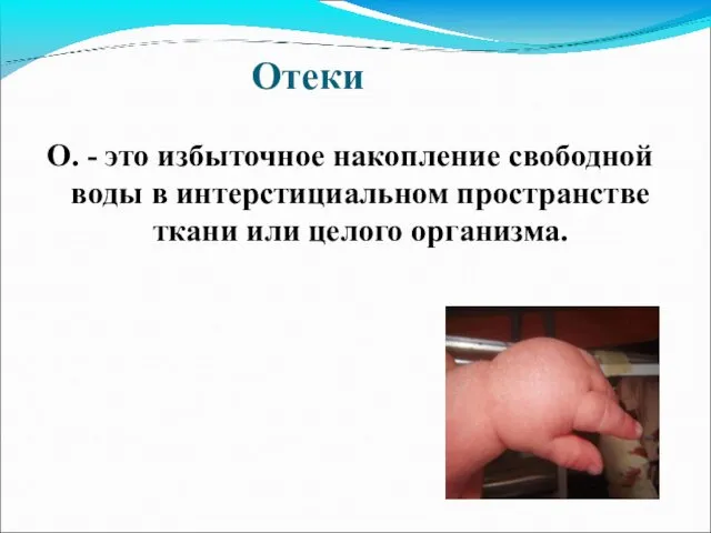 Отеки О. - это избыточное накопление свободной воды в интерстициальном пространстве ткани или целого организма.