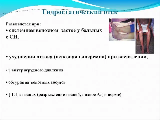 Гидростатический отек Развивается при: • системном венозном застое у больных