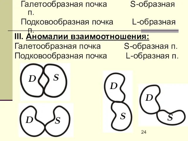 III. Аномалии взаимоотношения: Галетообразная почка S-образная п. Подковообразная почка L-образная