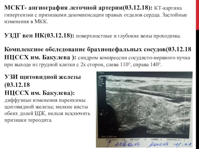 МСКТ- ангиография легочной артерии(03.12.18): КТ-картина гипертензии с признаками декомпенсации правых