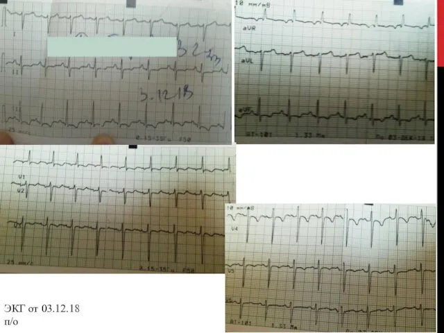 ЭКГ от 03.12.18 п/о