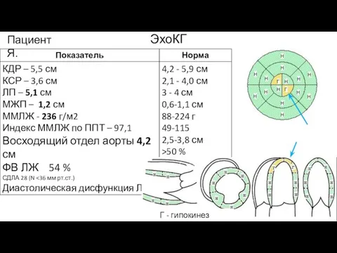 ЭхоКГ Пациент Я. Г - гипокинез