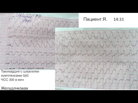 Пациент Я. 14:31 Тахикардия с широкими комплексами QRS ЧСС 300 в мин Желудочковая тахикардия ?