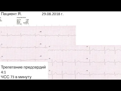 Пациент Я. 29.08.2018 г. Трепетание предсердий 4:1 ЧСС 73 в минуту