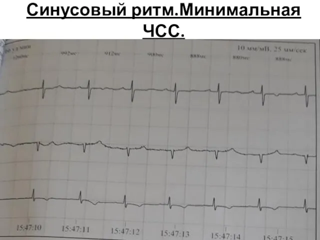 Синусовый ритм.Минимальная ЧСС.