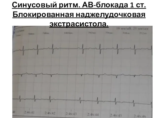 Синусовый ритм. АВ-блокада 1 ст. Блокированная наджелудочковая экстрасистола.