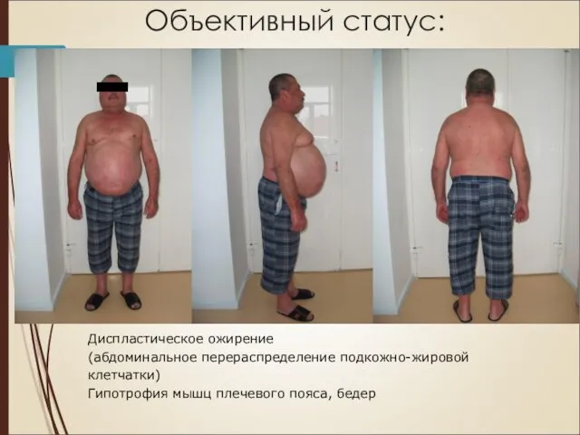 Объективный статус: Диспластическое ожирение (абдоминальное перераспределение подкожно-жировой клетчатки) Гипотрофия мышц плечевого пояса, бедер