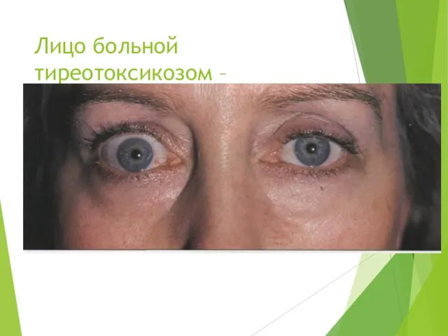 Лицо больной тиреотоксикозом – ассиметрия глаз