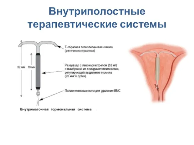 Внутриполостные терапевтические системы