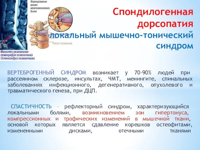 Спондилогенная дорсопатия - локальный мышечно-тонический син­дром ВЕРТЕБРОГЕННЫЙ СИНДРОМ возникает у