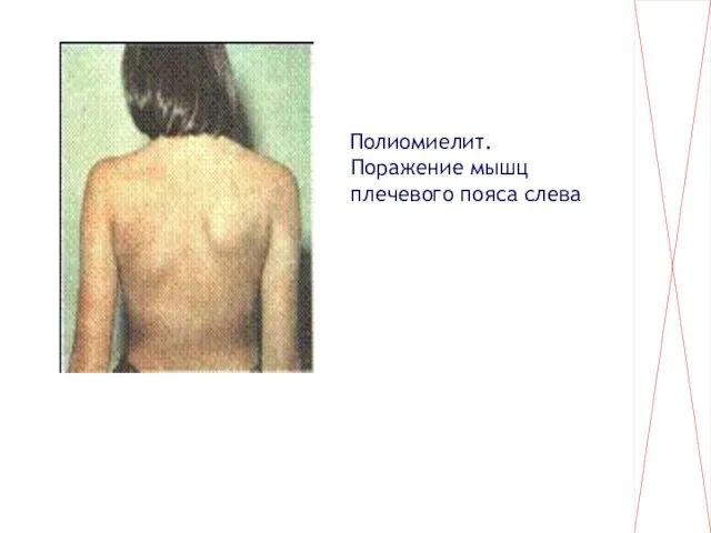 Полиомиелит. Поражение мышц плечевого пояса слева