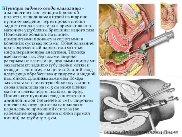 Пункция заднего свода влагалища - диагностическая пункция брюшной полости, выполняемая