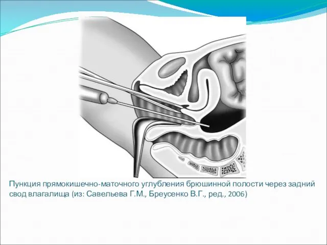 Пункция прямокишечно-маточного углубления брюшинной полости через задний свод влагалища (из: Савельева Г.М., Бреусенко В.Г., ред., 2006)