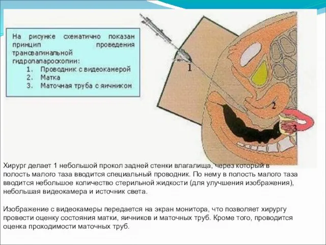 Хирург делает 1 небольшой прокол задней стенки влагалища, через который