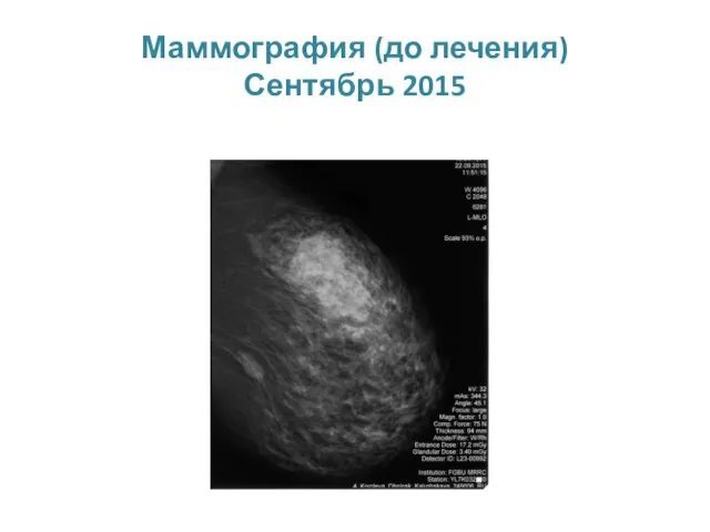 Маммография (до лечения) Сентябрь 2015