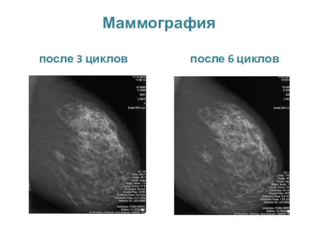 Маммография после 3 циклов после 6 циклов