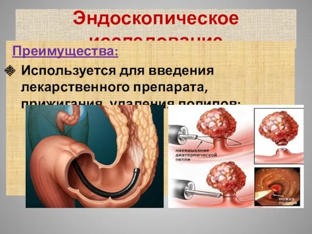 Эндоскопическое исследование Преимущества: Используется для введения лекарственного препарата, прижигания, удаления полипов;