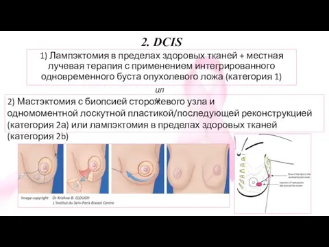 2. DCIS 1) Лампэктомия в пределах здоровых тканей + местная