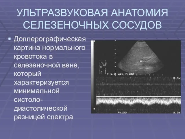 УЛЬТРАЗВУКОВАЯ АНАТОМИЯ СЕЛЕЗЕНОЧНЫХ СОСУДОВ Доплерографическая картина нормального кровотока в селезеночной вене, который характеризуется