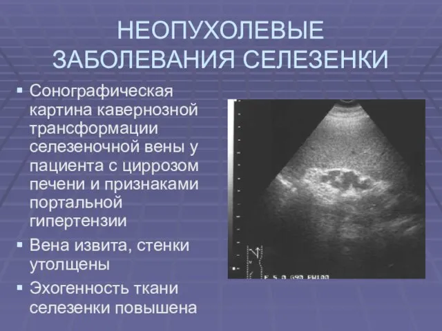 НЕОПУХОЛЕВЫЕ ЗАБОЛЕВАНИЯ СЕЛЕЗЕНКИ Сонографическая картина кавернозной трансформации селезеночной вены у пациента с циррозом