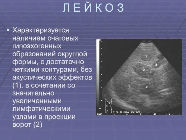 Л Е Й К О З Характеризуется наличием очаговых гипоэхогенных образований округлой формы,