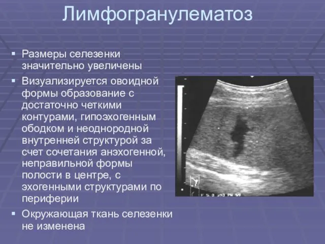 Лимфогранулематоз Размеры селезенки значительно увеличены Визуализируется овоидной формы образование с достаточно четкими контурами,