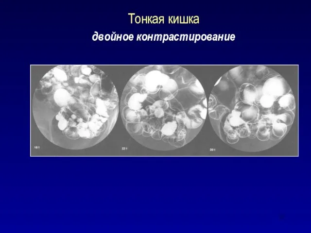 Тонкая кишка двойное контрастирование